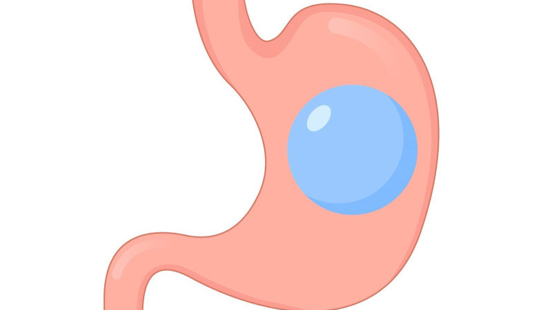 YUTULABİLİR MİDE BALONUYLA GÜVENİLİR ZAYIFLAMA